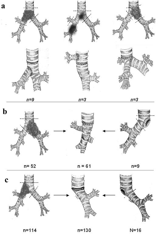 Different types of carinal resections: (a) the ‘complex reconstruction’ type of resections includes carina resection, preservation of intact lung, and formation of second anastomosis ‘end-to-side’; (b,c) sleeve resection of bifurcation with pneumonectomy or following pneumonectomy (for primary tumor or recurrence, main bronchus short stump fistula).
