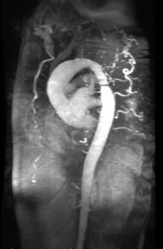 Preoperative magnetic resonance aortography demonstrates atypical coarctation in the proximal descending aorta. All arch branches are occluded. Collateral vessels to the vertebral arteries originate in the descending aorta.