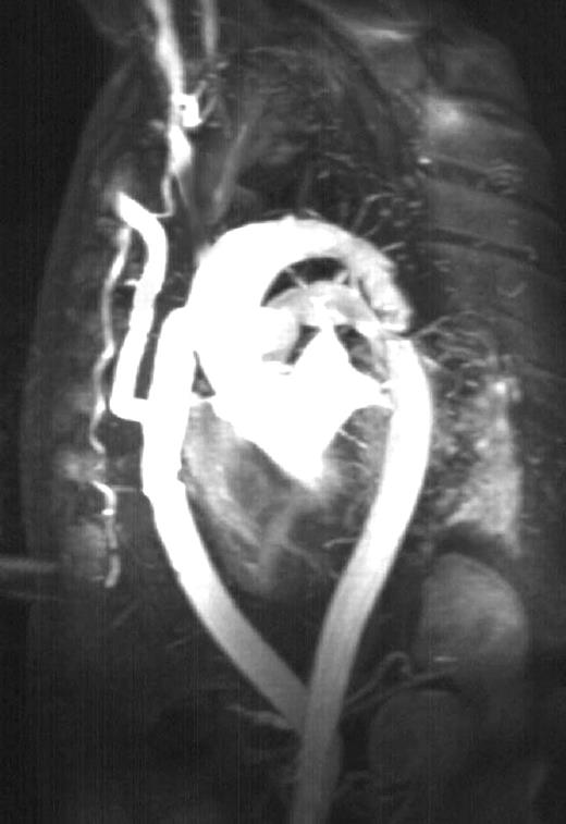 Postoperative magnetic resonance aortography demonstrates the patency of the aortic and axillary grafts.