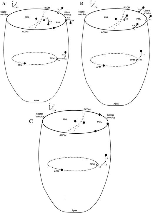 End-systolic 3-D marker positions before (open circles) and during acute left ventricular ischemia (filled circles) of the AML, PML, mitral annulus (oriented by the labels ‘SEPTAL ANNULUS’, ‘ACOM’ for anterior commissure, ‘PCOM’ for posterior commissure, and ‘LATERAL ANNULUS’), APM tip and PPM tip in the control (A); Duran (B); and Physio (C) groups. Statistically significant marker x-, y-, and z-displacements (mm) during LV ischemia relative to pre-ischemic values are depicted by bold arrows and displacements of possible statistical significance by the dashed arrows.
