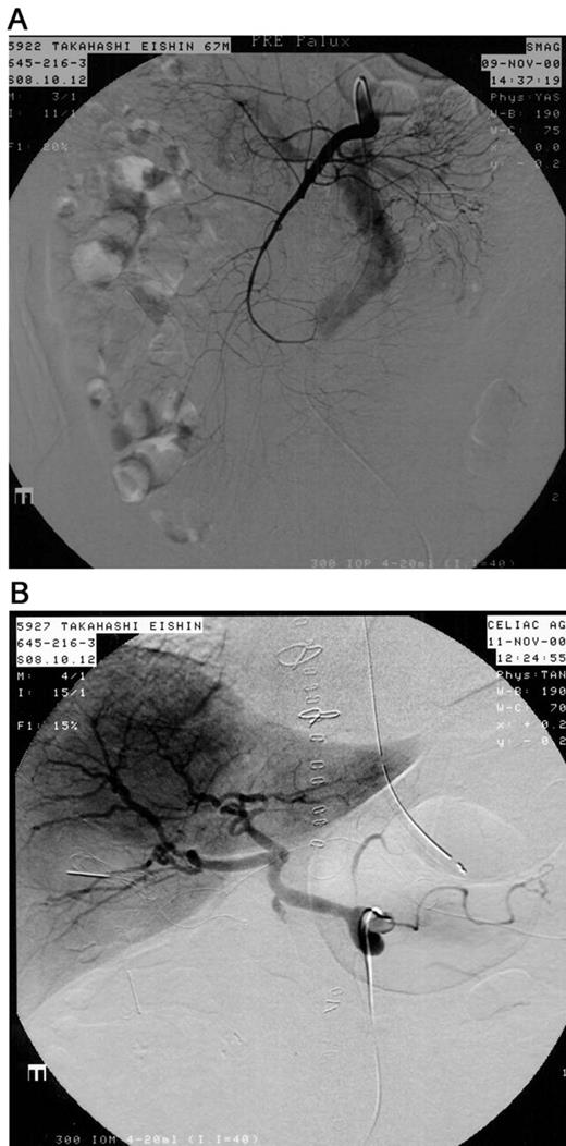 (A) The origin of the superior mesenteric artery appeared to be normal, but its branches were diffusely and severely narrowed. The blood flow was very slow, and the ileum and jejunum were not visualized. (B) The splenic artery, the left gastric artery, and the gastroduodenal artery were also extremely narrowed. Strikingly, the hepatic circulation appeared to be normal.