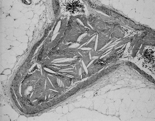 Cholesterol crystal embolism was detected in the arterioles and the small arteries of the resected ileum.