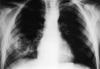 Chest roentgenogram at the time of admission showing the cystic lesion in the right lung along with contusion.