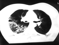 CT scan displaying infiltrates right-sided cystic lesions with an air-fluid level.