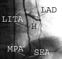 Selective left internal thoracic angiogram showing an H-graft at one week postoperatively. In this patient, the intercostal branches and distal LITA were kept patent. H=H-graft (using a right inferior epigastric artery segment); LAD=left anterior descending artery; LITA=left internal thoracic artery; MPA=musculophrenic artery; and SEA=superior epigastric artery.