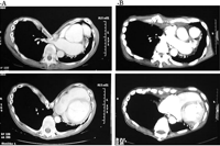 Pre- and post-operative chest computed tomographic findings. (A) Preoperatively, a severe excavation of the anterior chest wall and displacement of the mediastinum are recognized. (B) Postoperatively, the deformed wall is repaired, while the mediastinum remains displaced.
