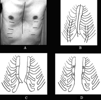 Operative procedures of funnel chest. (A) Skin incisions are shown. Seven incisions were made for resection of the convex costochondral junctions. After the resection, an ordinary median sternotomy was performed. (B) The right 4∼7th and left 5∼7th deformed ribs of 2∼3 cm in length are resected. (C) Application of a sternal retractor caused transverse fractures at the two sites of each divided sternum. The convex xyphoid process obstructed aligning the straightened sternum. (D) The deformed sawed sternum is repaired, being straightened by overlapping each fractured end and securing by wire fixation following resection of the redundant distal ends of the sternum. The sternum is sutured with wires in a usual fashion.