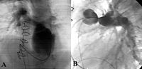 Angiograms showing (A) an aneurysmal dilatation extending from ventricular anastomosis to the proximal ring of the conduit (four chamber view), and (B) a stenosis of the pulmonary anastomosis, a non-dilated conduit and the perfect function of the valve (lateral view).