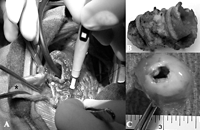 Macroscopic views during surgical retrieval of the Contegra conduit. Note the dilatation of the proximal part of the conduit (*) and the normal size between the two rings.