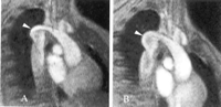 The increase in size of the aneurysm (white arrowhead) from 1998 (A) to 1999 (B).