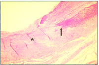 Histology showing loss of media (black arrow) and fibrous replacement (black asterisk).