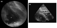 Images from left ventriculogram (A) and two-dimensional echocardiography (B) of the non-septal, tunneled interventricular communication running through the left ventricular wall and draining into the right ventricle. The arrows indicate the defect. LV, left ventricle; RV, right ventricle.