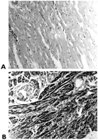 Histopathological sections and staining of the human auricle. (A) Control (group 1.1) myocardium: normal smooth muscle without changes in the myocytes (hematoxylin & eosin, original magnification; ×10); (B) X+OX (group 3.1) myocardium is intensely stained by myoglobin. Cytoplasmic vacuoli are observed in the myocytes that were sectioned perpendicularly (peroxidase–antiperoxidase stain, original magnification; ×20).