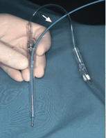 Probe (arrow) used in this experiment (Biosense Webster Inc., Johnson and Johnson, Diamond Bar, CA) coupled with a holder and a Ringer lactate continuous irrigation system. The electrode tip had a width of 2.3 mm.