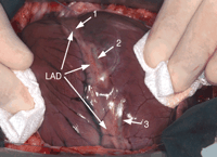 Three epicardial radiofrequency lesions (20 W, 20 s duration and 60 °C temperature), 2 cm in length made on the right side of the left anterior descending artery (LAD), respectively, at 1 mm (1), 5 mm (2), and 10 mm (3) away from the artery.