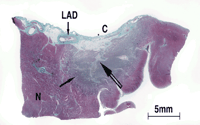 Radiofrequency effect is well delimited with central myocardial coagulative necrosis (double arrow) surrounded by contraction band necrosis (single arrow) (Gomori trichrome stain). Half of the diameter of the left anterior descending artery (LAD) is involved. C represents the point of RF application. N is the normal myocardium.