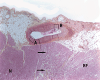 Higher magnification of Fig. 5. Arrows indicate the limit of radiofrequency effect area (RF) on epicardial myocardium. Left anterior descending artery enlarged at the origin of a diagonal artery. Half of the artery was in contact with the area exposed to RF (HES stain, ×25). A is a part of the artery not exposed to RF and B a part exposed to RF effect. N is the normal myocardium.