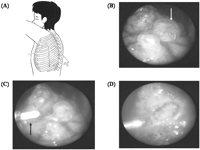 Patient in the lateral position, with placement of the three 2-mm ports. (B) Endoscopic view showing bullae (arrow) less than 2 cm in size on the apex. (C) Endoscopic ablation using Nd: YAG laser fiber (arrow) for bullae. (D) The disappearance of bullae. Schema of the port placement.