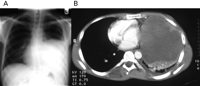 (A) Baseline plain chest X-ray; and (B) baseline contrast CT-scan.