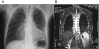 Plain chest X-ray (A); and MRI scan (B) following six cycles of chemotherapy and consolidation radiotherapy.