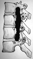 Extended foraminectomy. The opening connecting three foramina. Dashed line around the processus transversus illustrates possibility of its removal.