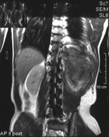 Magnetic resonance imaging of the thoracic dumb-bell tumor—axial reconstruction (patient no. 3).