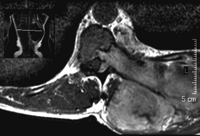 Magnetic resonance imaging of the thoracic dumb-bell tumor—normal scan (patient no. 3).
