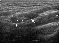 Gray-scale sonogram showing a longitudinal scan of a normal upper cervical node which is hypoechoic and elliptical in shape (large arrows). The lymph node demonstrates an echogenic hilus (small arrows), which is continuous with the adjacent soft tissues (arrowheads).