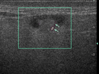 Power Doppler sonogram showing a normal parotid lymph node with hilar vascularity (arrows).