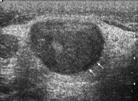 Gray-scale sonogram showing a transverse scan of a metastatic supraclavicular node (arrows). The lymph node is hypoechoic, well defined, round shaped and without echogenic hilus.