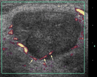 Power Doppler sonogram of the same lymph node in Fig. 3. Note that the lymph node shows peripheral vascularity, which is along the periphery of the node and enters the node (arrows).