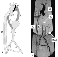 (a) History of multiple surgeries. (A) At the age of 31 years. (B) At the age of 51 years. (C) At the age of 60 years. (b) Preoperative aortography: (#1) total clamping of the descending aorta; (#2) patent bypass from the ascending aorta to bilateral iliac arteries; and (#3) occlusion of the abdominal aorta just above renal arteries. IMA, inferior mesenteric artery.