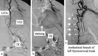 Selective angiography. (a) The left eighth (VIII) and ninth (IX) intercostal arteries were visualized from the LITA. (b) The ninth intercostal artery supplied fine collaterals to the thoraco-abdominal aortic aneurysm and left dye staining. (c) From the left sixth intercostal artery supplied by a mediastinal branch of the thyrocervical trunk, an anterior spinal artery (bold arrows) was visualized through a hairpin-curved radicular artery (thin arrows).