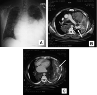 Chest radiograph (A) and thoracic CT with intravenous contrast enhancement at the level of the pulmonary trunk bifurcation (B) and the lower thorax (C). There is a huge isodense soft tissue mass with speckles of calcification in the left lung. Enhancing serpiginous vessels characteristic of a pulmonary arteriovenous malformation are seen within the mass (arrowed). Prominent feeding vessels arising from the left main pulmonary artery favor a diagnosis of arteriovenous malformation rather than pulmonary sequestration, the major differential diagnosis. A component of the lesion with mixed fat and soft tissue content extends over the posterior mediastinum to the right hemithorax. The whole lesion causes gross displacement of the heart anteriorly and significant contralateral mediastinal shift.