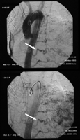 Arch aortogram with pulmonary angiography illustrating the large pulmonary arteriovenous malformation. In addition to the pulmonary arterial supply, there are also feeding vessels from the left internal mammary, left bronchial, left phrenic, and at least four intercostal arteries, which are normally more typical of pulmonary sequestration. The feeding vessels are dilated and tortuous distally when approaching the lesion (arrowed).