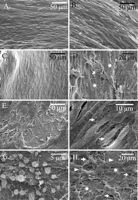 Scanning electron micrographs of human radial artery endothelium. Control samples were incubated only with heparinized blood and papaverine-treated samples were treated with intraluminal papaverine–NaCl solution for 5 min prior to incubation in heparinized blood. Control samples. Panel A: Morphologically intact endothelium. The sample was incubated in heparinized blood for 13 min. Patient number 2. Panel B: Morphologically intact endothelium. The sample was incubated in heparinized blood for 65 min. Patient number 11. Panel C: Morphologically intact endothelium. The sample was incubated in heparinized blood for 54 min. Patient number 10. Papaverine-treated samples. Panel D: Severely damaged endothelium with detaching endothelial cells (arrow) in the middle of a denuded area (asterisks). The sample was incubated in heparinized blood for 54 min after papaverine treatment. Patient number 10. Panel E: There were numerous large denuded areas and widened intercellular spaces in the papaverine-treated samples. The sample was incubated in heparinized blood for 65 min after papaverine treatment. Patient number 11. Panel F: Pore-like structures in individual endothelial cell (arrows). The sample was incubated in heparinized blood for 54 min after papaverine treatment. Patient number 10. Panel G: Platelets attached to the exposed subendothelial collagen. The sample was incubated in heparinized blood for 65 min after papaverine treatment. Patient number 11. Panel H: Damaged endothelium with locally denuded areas (asterisks), numerous widened intercellular spaces (arrows) and some fibrin strands (arrow-heads) attached to the exposed collagen. The sample was incubated in heparinized blood for 65 min after papaverine treatment. Patient number 11.