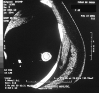 Contrast-enhanced computed tomography scan showing a 2 cm round nodule in the lower left lung lobe measuring 118.4 Hounsfield units.