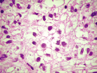 Microscopic findings. This section of the tumor shows cells with clear cytoplasm and regular nuclei in size. No mitotic figures were seen (H&E stain, original magnification 400×).