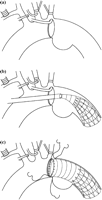 Procedure for conventional transaortic stent-grafting. A hemicircular aortotomy was performed on the anterior wall of the proximal arch aorta under selective cerebral perfusion and hypothermic systemic circulatory arrest (a). A sheath catheter was inserted into the descending thoracic aorta via a small aortotomy and advanced beyond the distal end of the aneurysm. The distal end of the stent-graft was adequately positioned under TEE guidance (b). The proximal end of the stent-graft was sutured onto the posterior aortic wall intraluminally and the anterior aortic wall transmurally through the aortotomy. The aortotomy was closed with the anterior wall of the proximal end of the stent-graft (c).