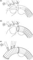 Procedure for hybrid transaortic stent-grafting. The aortic arch was transected proximal to the left subclavian artery and a stent-graft was inserted into the descending aorta (a). The proximal end of the stent-graft was sutured circumferentially to the transected aortic arch (b). The ascending and the proximal aortas were replaced with a branched graft, which was anastomosed to the proximal end of the stent-graft (c).