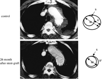 Shrinkage of the aneurysmal diameter as measured by transectional CT slices. The excluded aneurysmal space was evaulated by measuring the diameter of the aneurysm, not including the diameter of the stent-graft at 1 month (control) after surgery and each follow-up period. Percent shrinkage of the excluded aneurysm was calculated by comparing the diameter of the aneurysm at its maximum size (M, at 1 month; M′, at 26 months after stent-grafting) to the excluded aneurysmal space (E, at 1 month; E′, at 26 months after stent-grafting), which was the space excluded by stent-grafting (S, stent-graft) at each period.