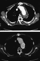 Complete disappearance of the excluded aneurysmal space. This patient showed extreme shrinkage of the excluded aneurysmal space, which vanished completely during the follow-up period (14 months after stent-graft).