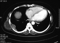 Enhanced chest computed tomography shows a protrusive chest wall mass measuring 5×5×3cm, communicating into the right pleural thickening.