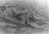 Pathologic findings shows rheumatoid nodule containing layer of palisaded epitheloid histiocytes adjacent to necrotic debris.
