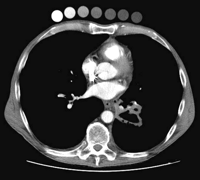 Seven specimens of Betadine® solutions at concentrations of 100, 50, 20, 10, 5, 2, and 0% (from left to right) have been taped onto the anterior chest wall of a patient prior to an intravenous contrast enhanced helical CT survey of the chest and abdomen for a 5cm excavated carcinoma of the left lower lobe. It appears on this 5mm CT section obtained at 120kV and 120mAs, that Betadine® solution at a concentration of 50% provides an attenuation value of 240 Hounsfield units, which is close to the one in the contrast enhanced lumen of the descending thoracic aorta.