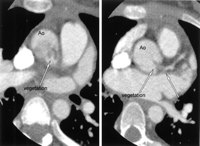 Enhanced computed tomography revealed a 4×2cm mass in the proximal ascending aorta, plugging in the left coronary main trunk (Ao, ascending aorta; LMT, the left coronary main trunk).
