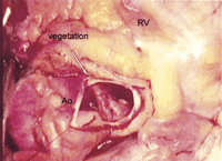 A friable vegetation (4×2cm) arising from the posterior aneurismal aortic wall was observed (Ao, ascending aorta; RV, right ventricle).