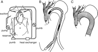 (A) The assisted circulation is shown. Left heart bypass was switched to SCP by placing clamps on 3 arch vessels. (B) After the arch vessels were divided and closed, the extra-anatomical bypass was constructed. A stent-graft delivery system was advanced into the aortic arch. (C) An extended aortic arch aneurysm was treated with the MK stent graft, which was constructed from a nitinol framework of MK stent and polyester fabric and inserted into the aortic arch.