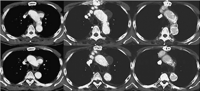 A 67-year-old male with aortic arch aneurysm. (A) Preoperative enhanced CT scan demonstrates a true sacclar aneurysm in the aortic arch. (B) Enhanced CT scan obtained 1 month after MK stent-graft placement revealed complete exclusion of the aneurysm without endoleak. (C) 9 months after the procedure, enhanced CT scan showed that the aneurysm in the aortic arch was almost vanished.