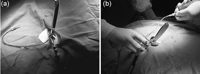 (a) A port was placed in the midaxillary line of the sixth or seventh intercostal space, the scope was introduced and all organs in the left hemithorax were explored, (b) 200ml of blood was taken from the jugular vein and injected into the pleural cavity with a serum line through the scope after pleural abrasion.
